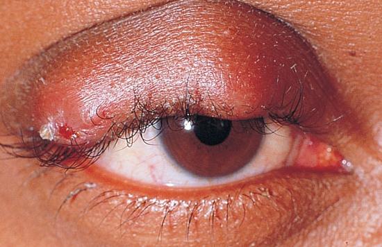 下瞼のは虫類 - 認識と治療の方法